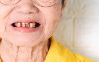 Soluzioni per anziani senza denti: impianti dentali o ricette gustose e morbide